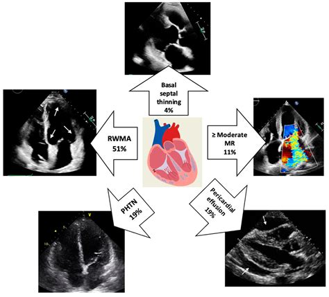 rwma echocardiogram left ventricle